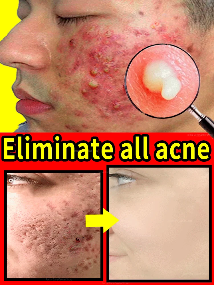 Akne Removal Cream Anti Obraz Znamke Sredstvo Serum